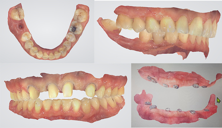 Panda P2 Intraoral Scan